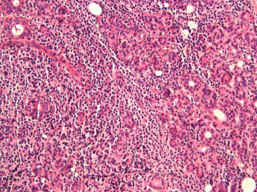 Lymphocytic infiltration of the parotid gland in a patient with sjögren syndrome