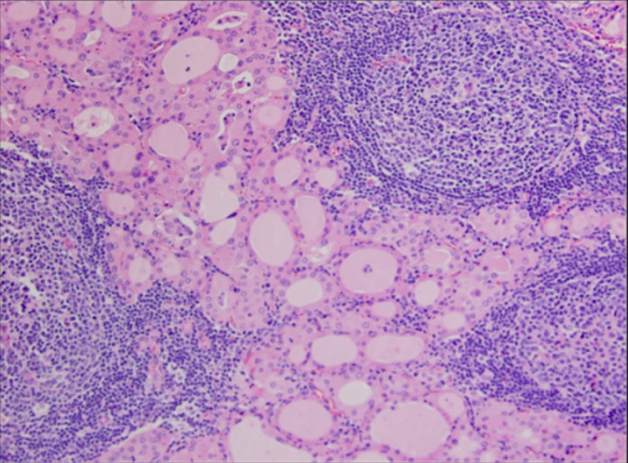 Tecido linfoide na tiroidite de hashimoto