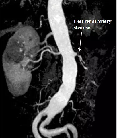 Mra showing left renal artery stenosis