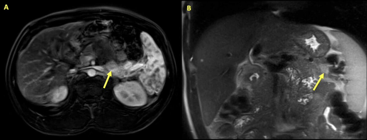 insulinoma on mri sag localizer