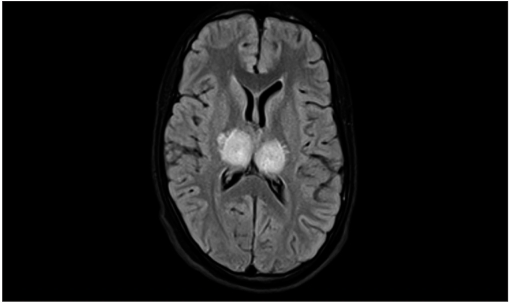 Mri t2-weighted flair image