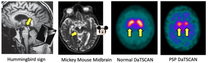 Características de mri y datscan (prueba de imagen nuclear que permite a los médicos ver los niveles de dopamina del cerebro) en psp