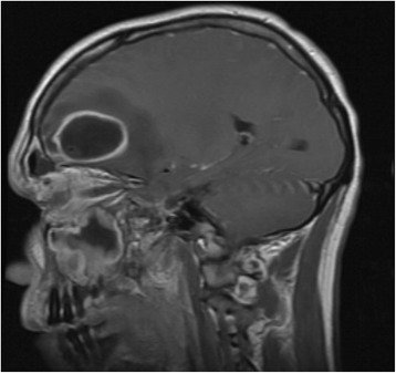 Head mri showing frontal abscess