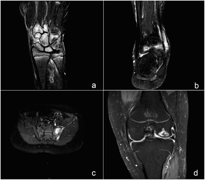 Mri findings of frequently involved joints in jia