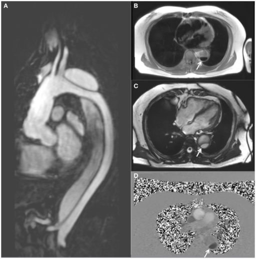 Mri images demonstrating a descending thoracic aortic dissection