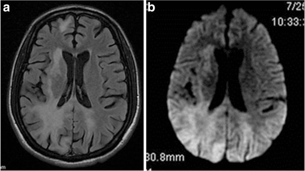 Leucoencefalopatia multifocal de imagens de ressonância magnética