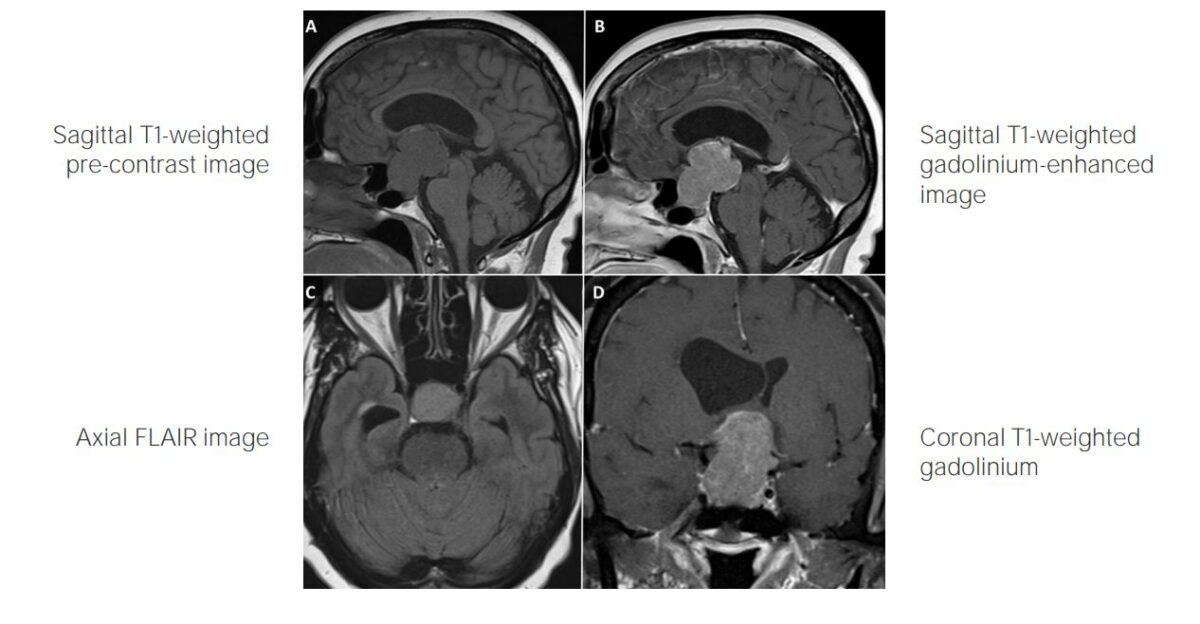 Imagem de ressonância magnética de craniofaringioma