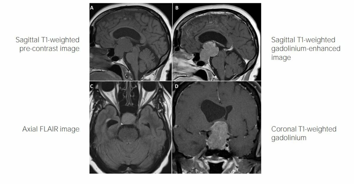 Imágenes de una rm del craneofaringioma