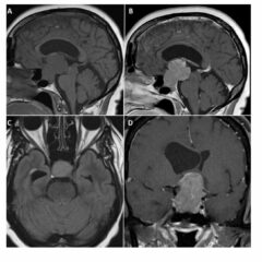 MRI imaging of craniopharyngioma
