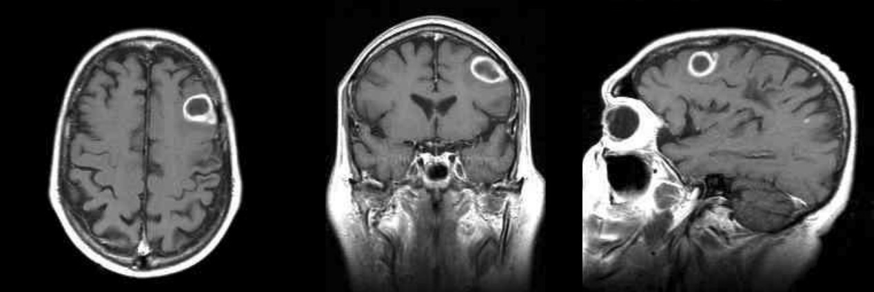 Mri of a brain abscess showing the classic “ring enhanced” lesion