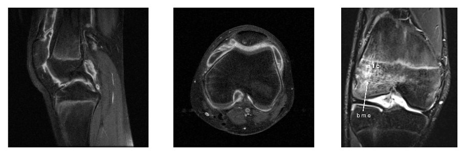 Mri of a knee in a patient with juvenile idiopathic arthritis