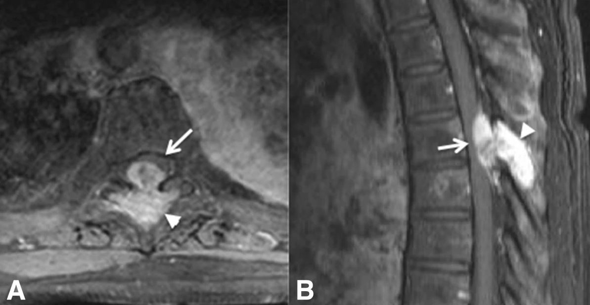 Mri of a patient with pcs