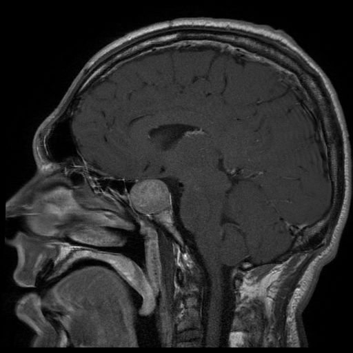 Mri of a patient with a large pituitary adenoma resulting in acromegaly
