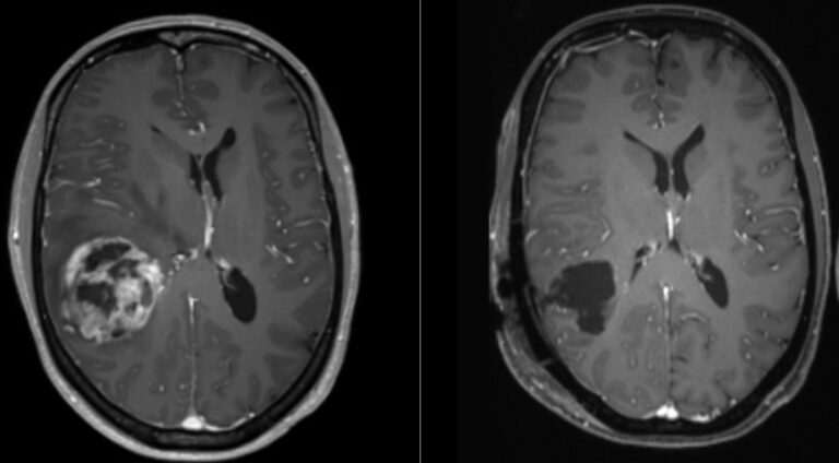 Glioblastoma Multiforme | Concise Medical Knowledge