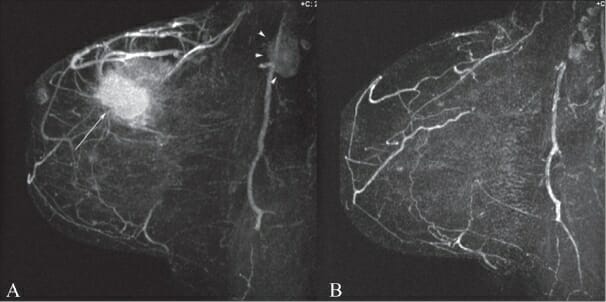 Mri of breast before and after chemotherapy