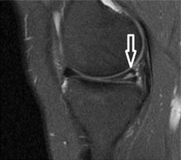 Mri of the knee shows horizontal tear