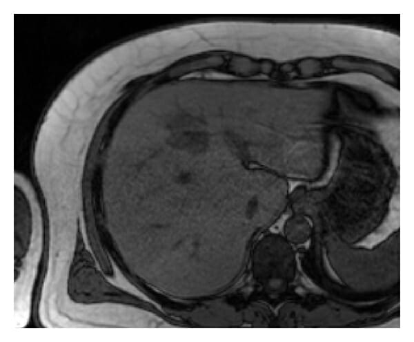 Mri of the liver showing an abscess a