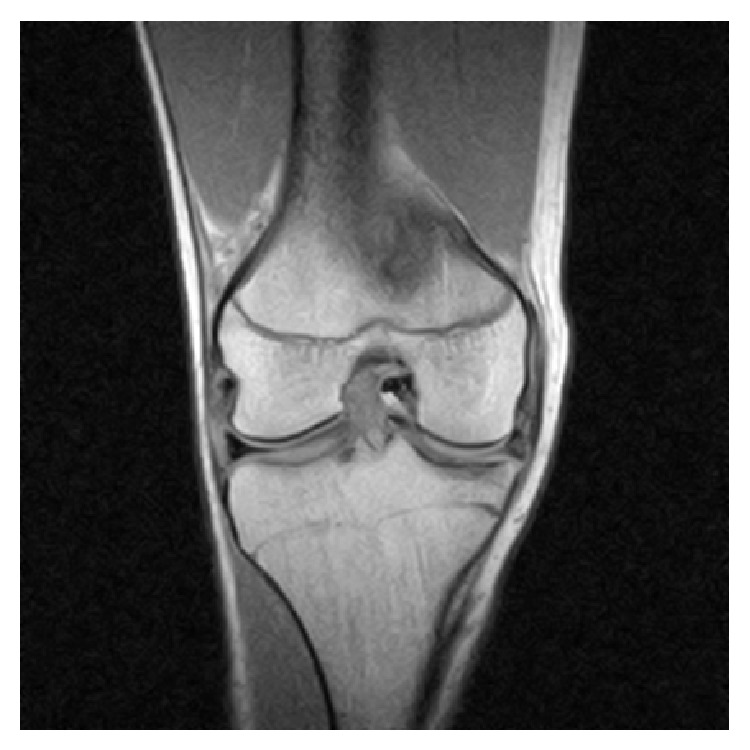 Mri of the right knee revealing intra-articular and bucket-handle medial meniscus tear