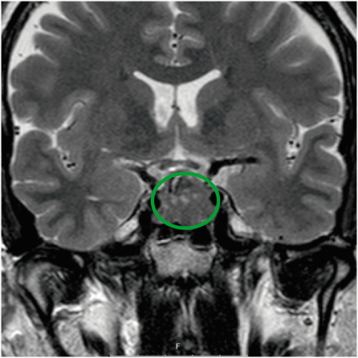 Mri pituitary tumor coronal view