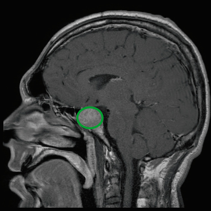 Mri pituitary tumor sagittal view