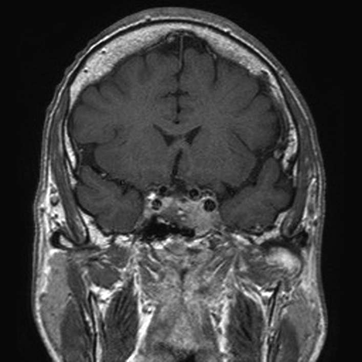 Mri pituitary tumor unmarked