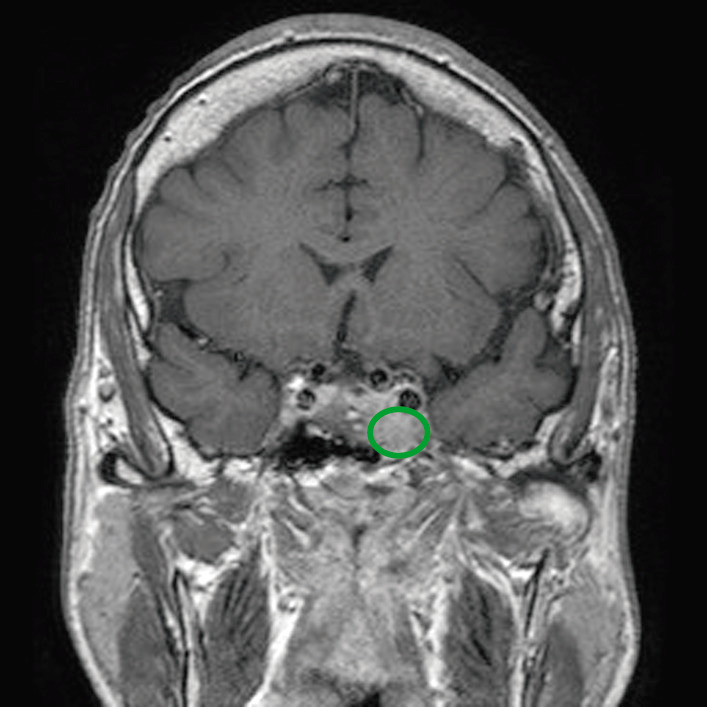 pituitary tumor mri