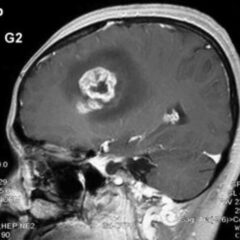 MRI scan glioblastoma enhanced