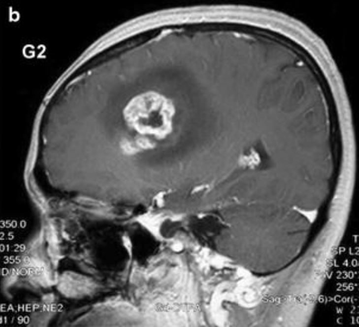 Mri scan glioblastoma enhanced
