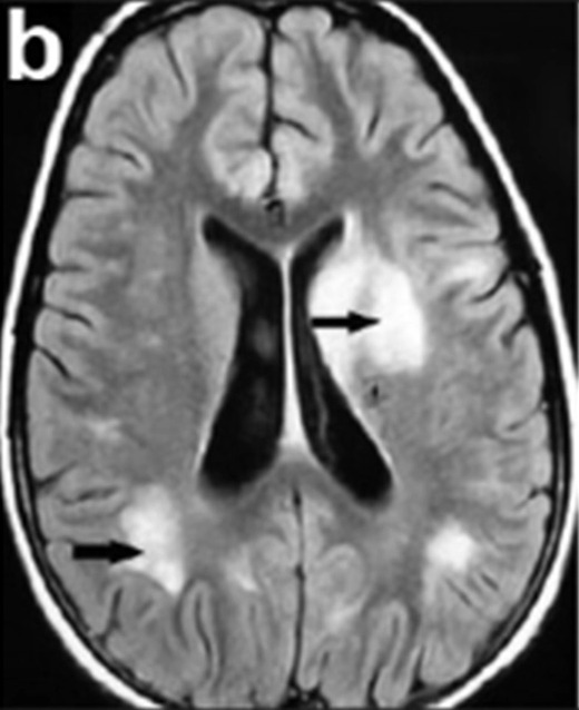 Exame de ressonância magnética de um paciente com encefalomielite disseminada aguda (adem)