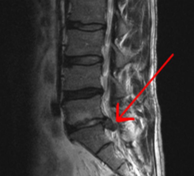 Mri scan of large extrusion of the disc