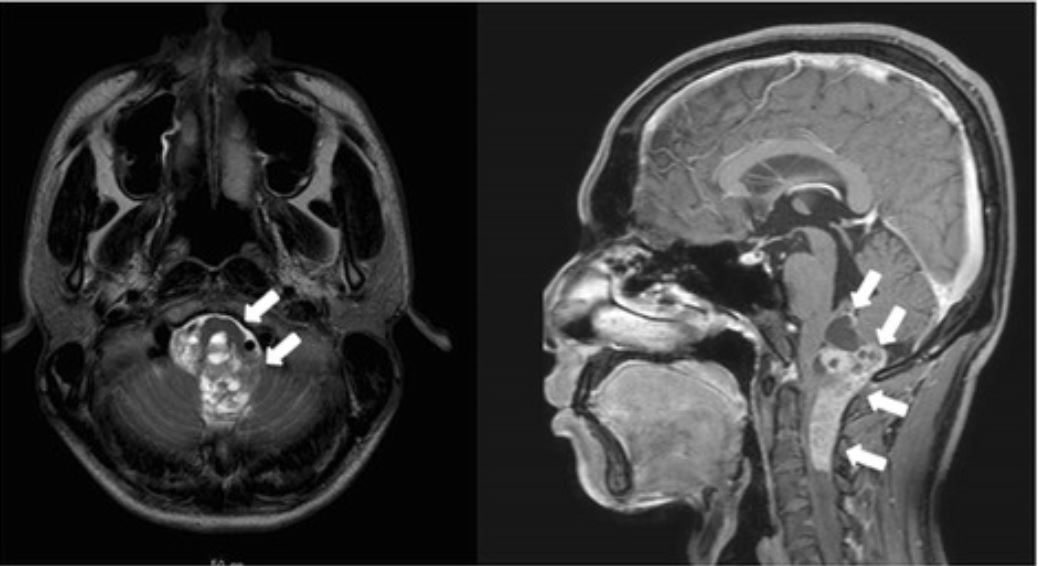 A ressonância magnética revela um ependimoma anaplásico