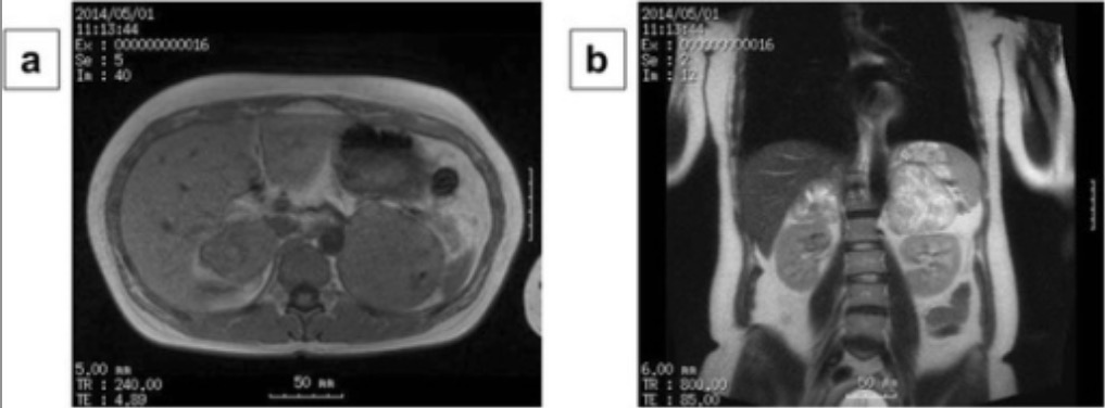 Mri showing bilateral adrenal pheochromocytomas with central necrosis