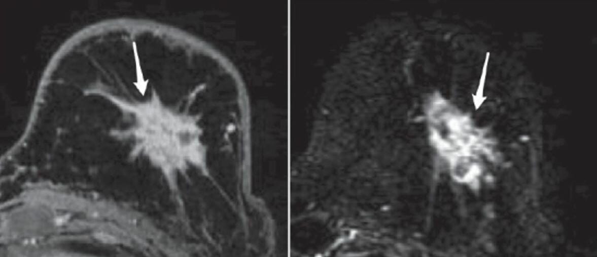 Mri with contrast shows a heterogeneously enhancing irregular mass with spiculated margins, suggestive of breast cancer