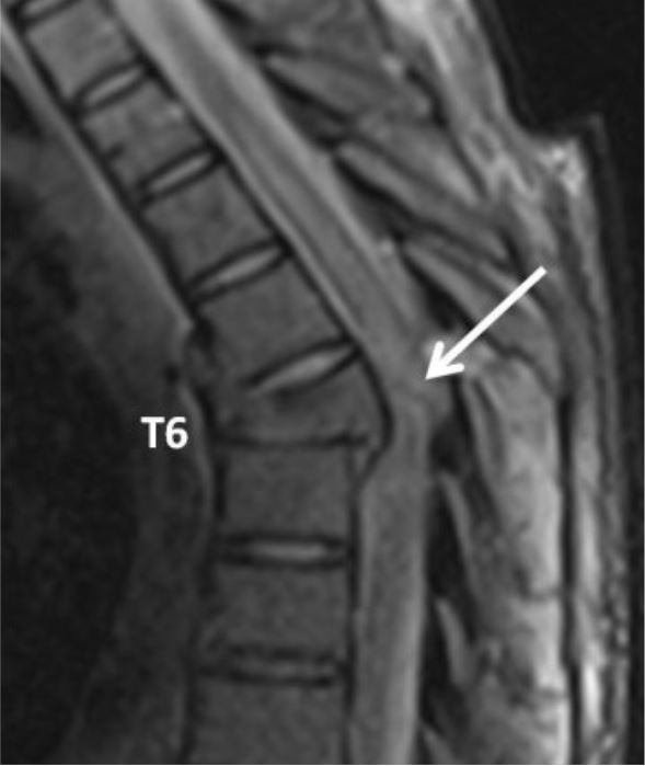 Mri of spinal cord injury