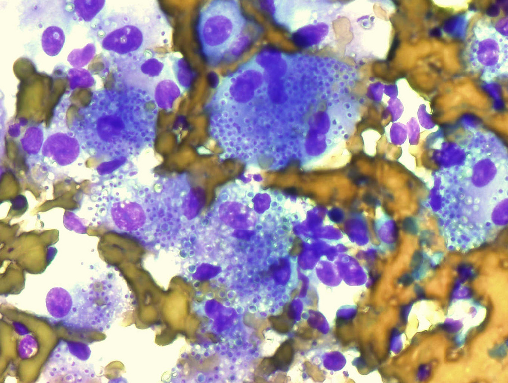 Macrophages in lymph node histoplasma capsulatum