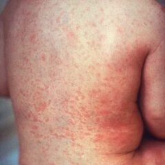 Macular rash of rubella on the skin of a child’s back