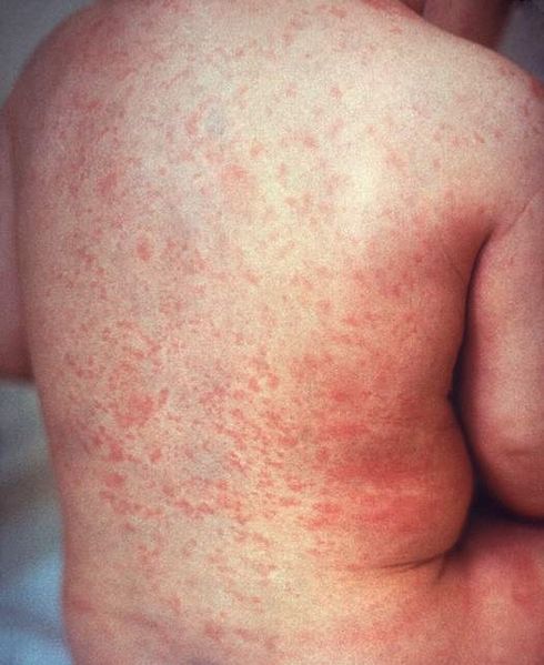Macular rash of rubella on the skin of a child’s back