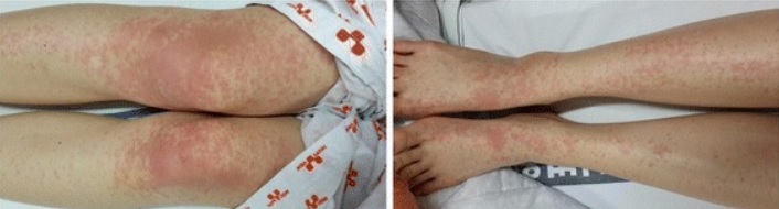 dengue hemorrhagic fever rash