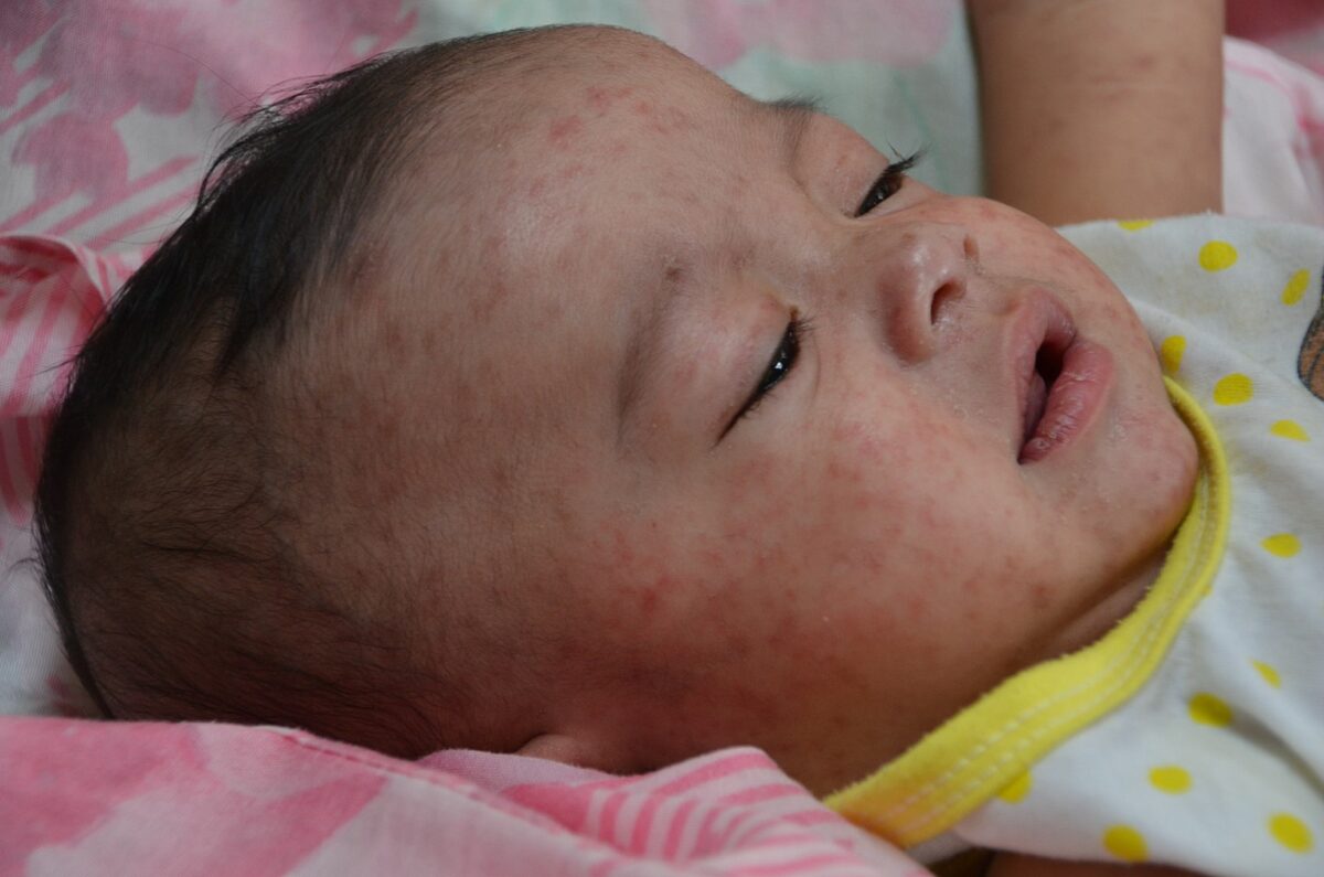 Maculopapular rash on the face of a child with measles