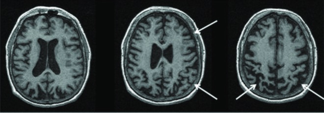 Doença de Niemann-Pick  Concise Medical Knowledge