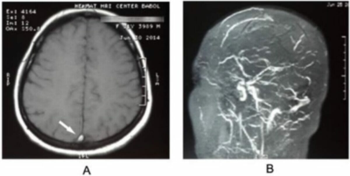 A ressonância magnética do cérebro mostrou sinal delta vazio