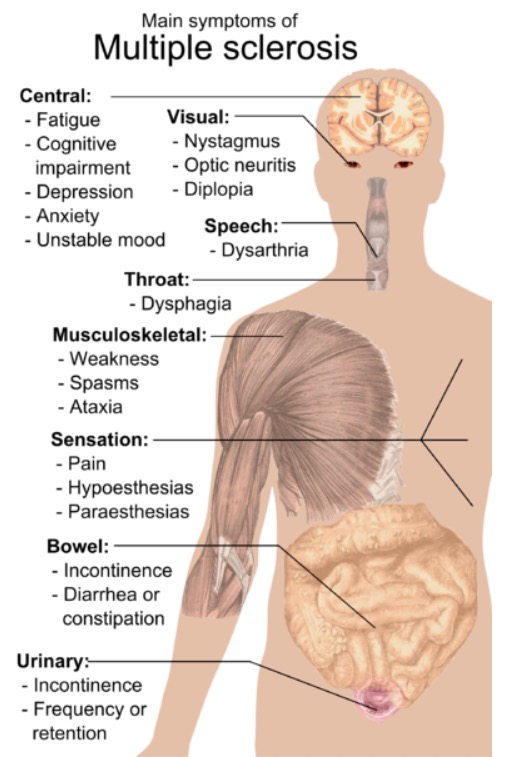 Main symptoms of multiple sclerosis