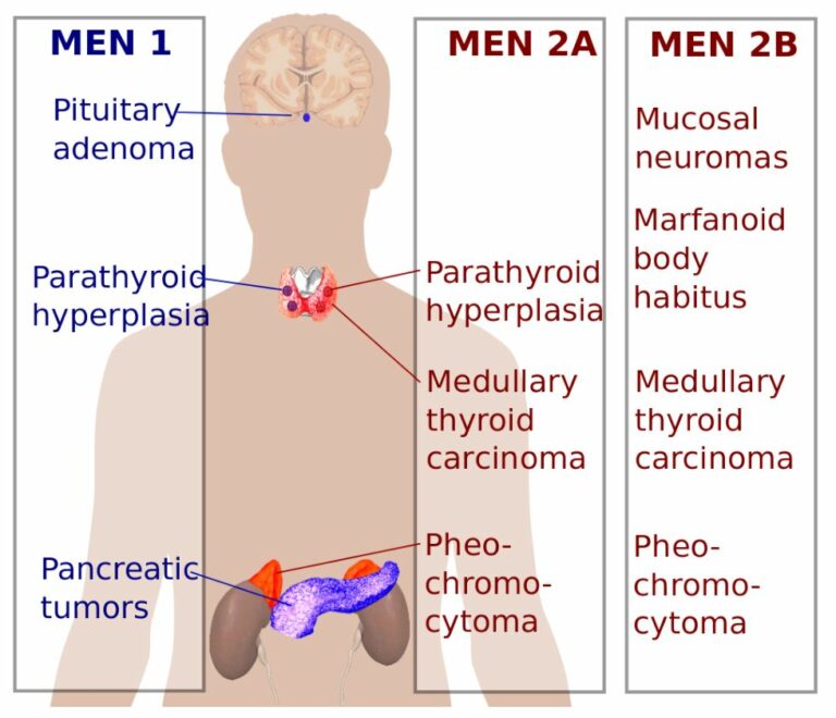 Multiple Endocrine Neoplasia Concise Medical Knowledge