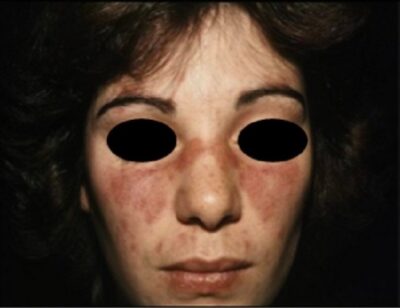 Sle Rashing Systemic Lupus Erythematosus | Concise Medical Knowledge