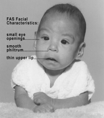 Male baby with fas syndrome
