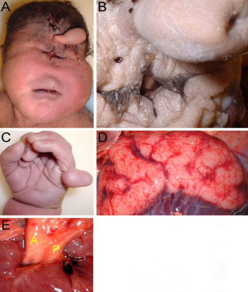 Male infant with patau syndrome