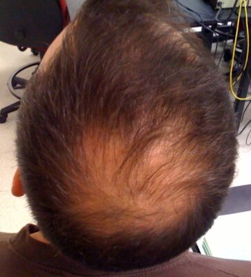 Alopecia | Concise Medical Knowledge