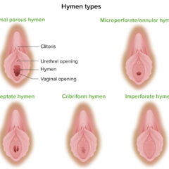 Malformations of hymen