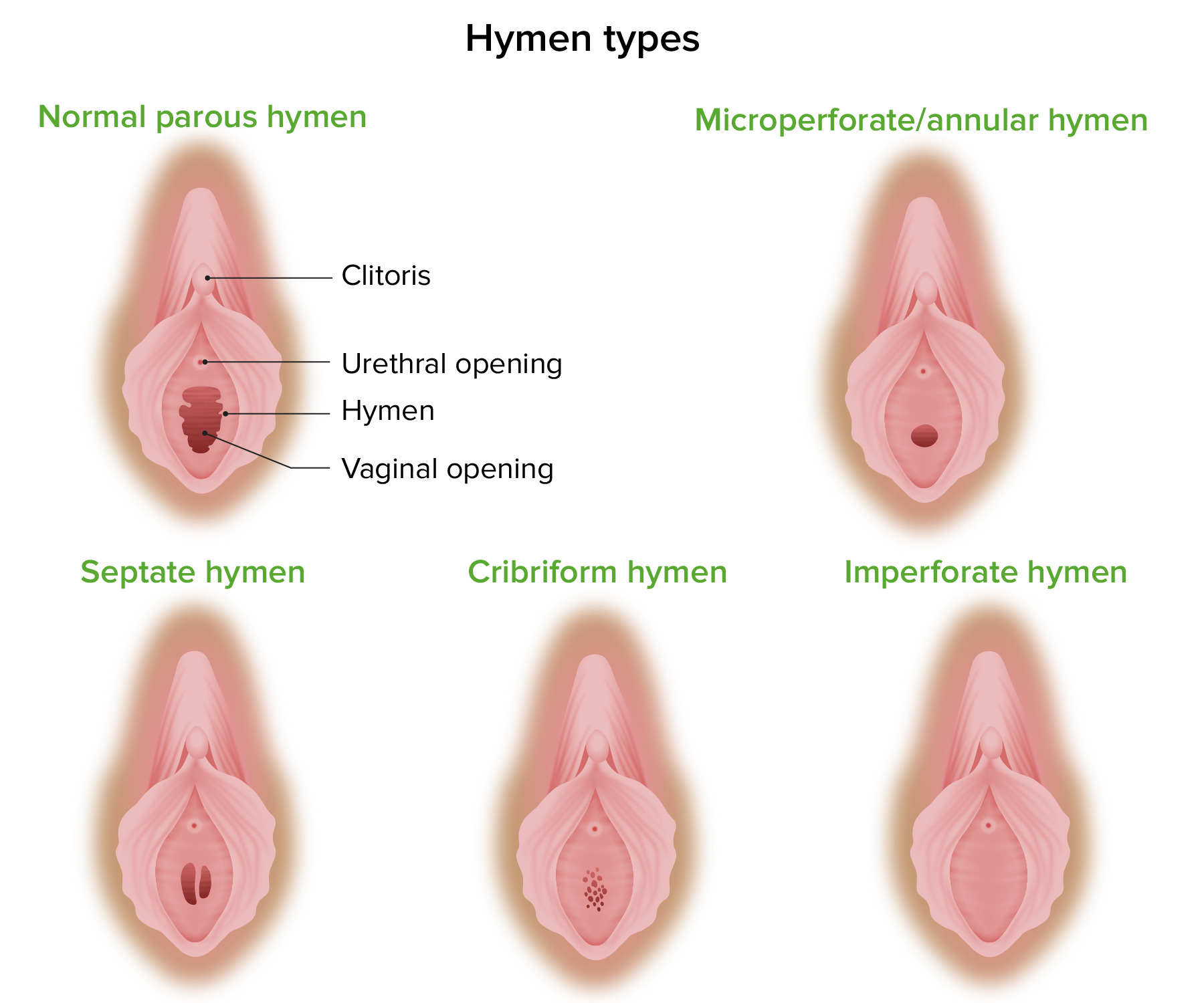 Hymen sex septate Hymen abnormalities: