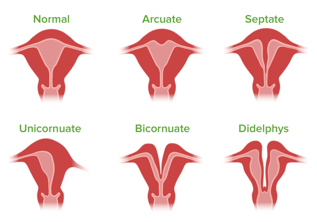 Congenital Uterine Anomalies Most Common Structural Defect Of Uterus Sexiz Pix 7843